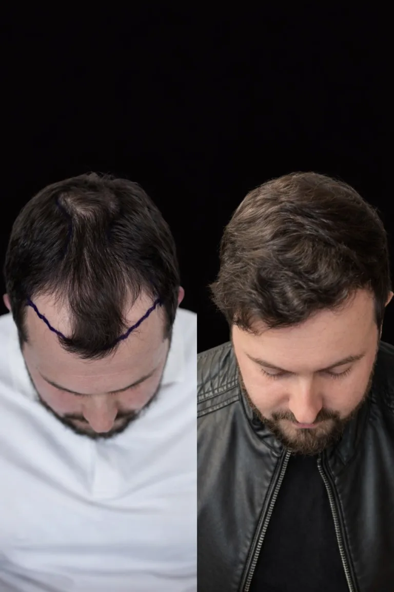 Cosmeticium patient before and after hair transplant