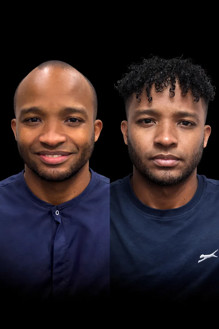 Cosmeticium patient before and after hair transplant