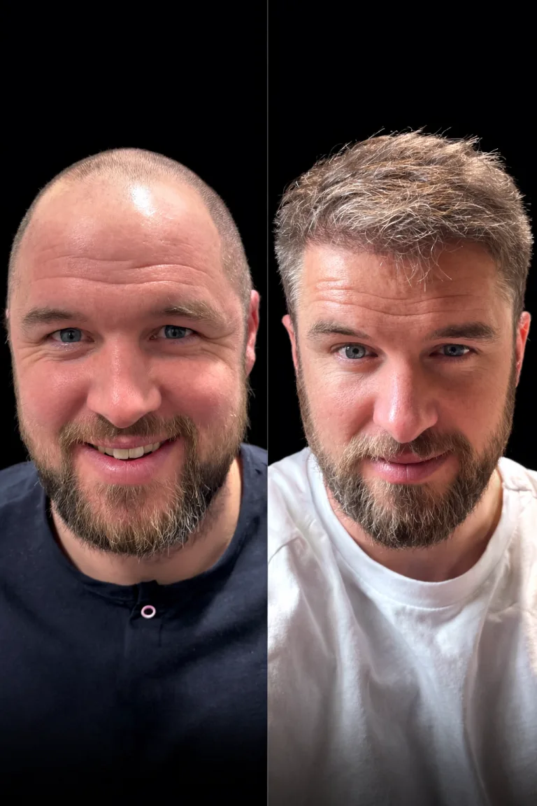 Cosmeticium patient before and after hair transplant